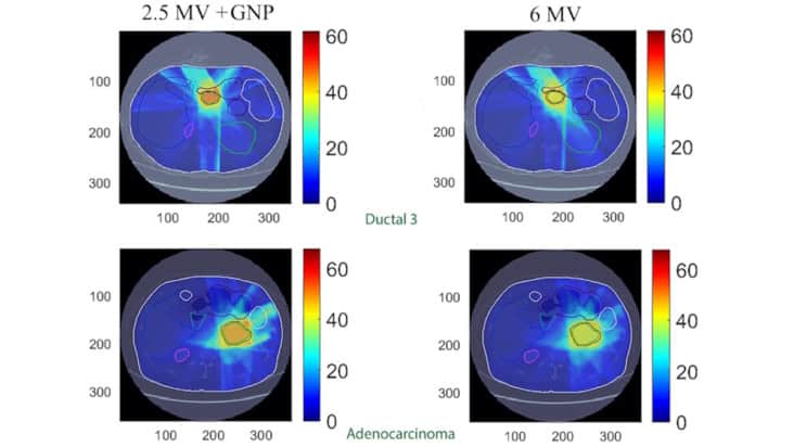 Dose distributions for pancreatic radiotherapy