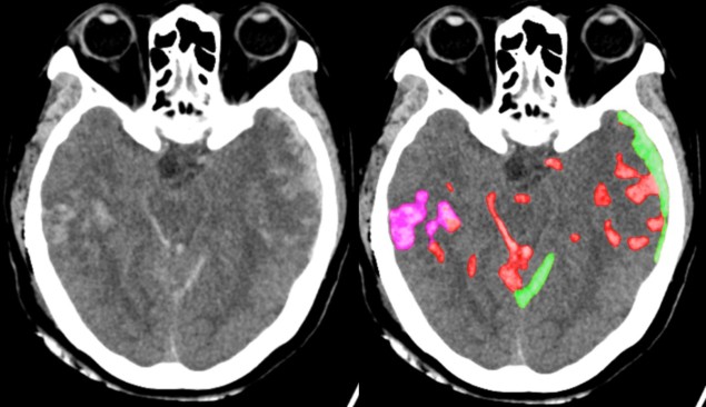 Head CT