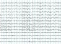Electroencephalogram